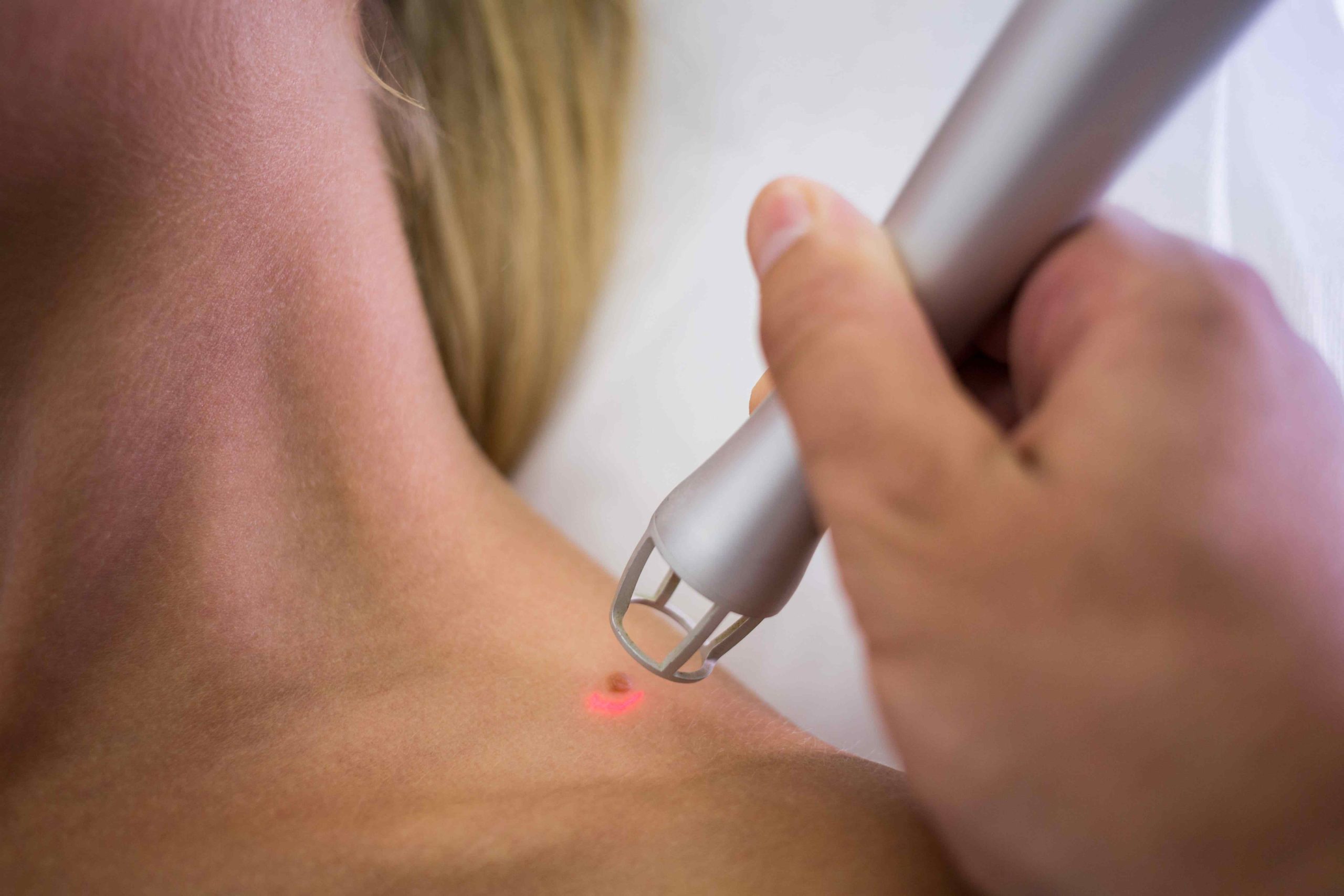 Laser é uma das tecnologias fotônicas usada na medicina, na dermatologia, remove manchas e pintas.Foto:Freepik